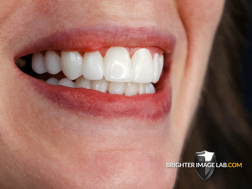 BIL Veneers® (Test Copy)