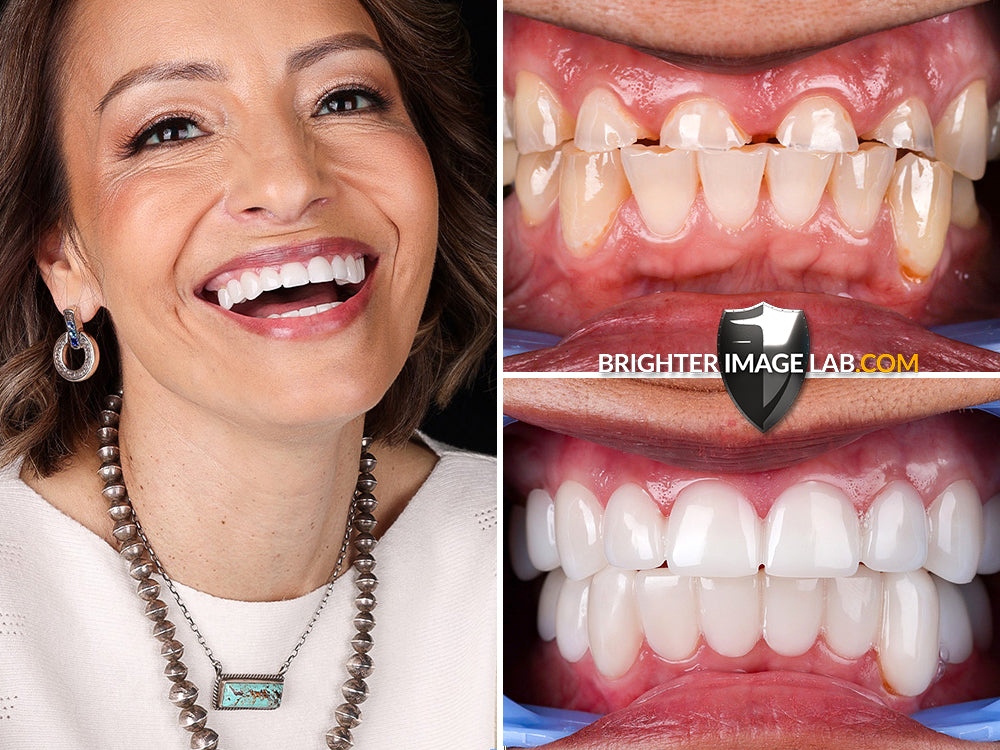 IncrediBIL Veneers® (Test Copy)